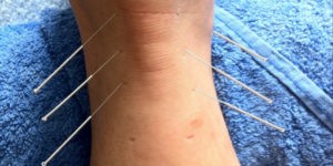 Leczenie kontuzji ścięgna achillesa