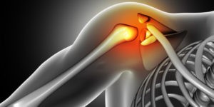 Leczenie zespołu ciasnoty barkowej