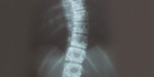 leczenie skoliozy rzeszów