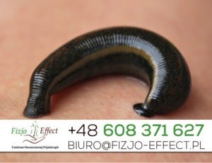 leczenie pijawkami lekarskimi rzeszów