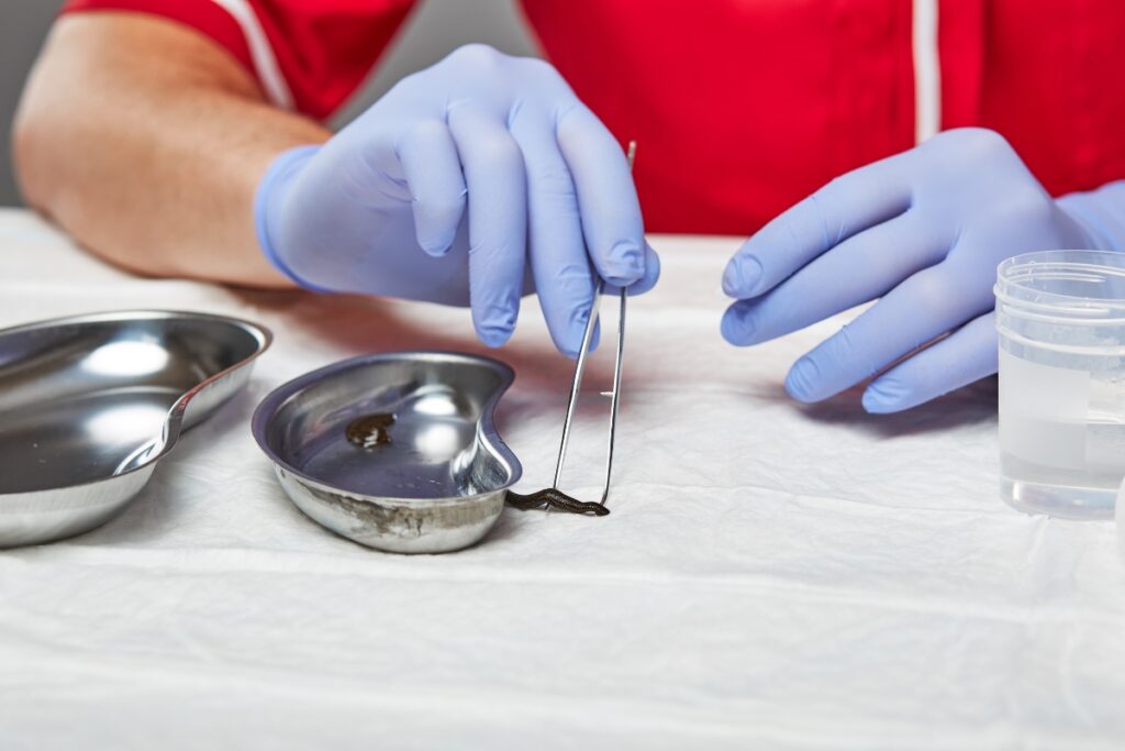 Pijawki na dnę moczanową